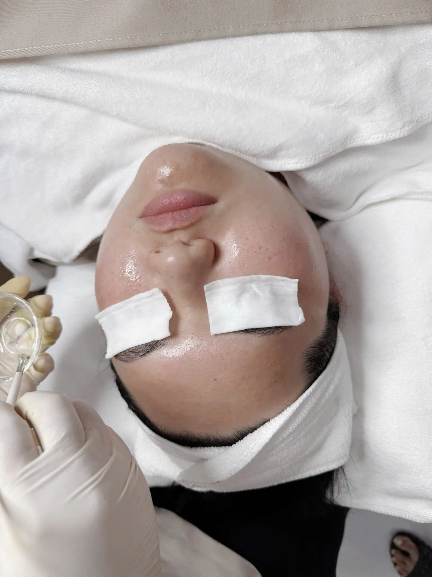Peel Trị Thâm – Sáng Da – Đều Màu (Có Bong)